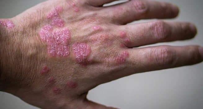 Psoriasis: Causes, Triggers, Treatment, and More