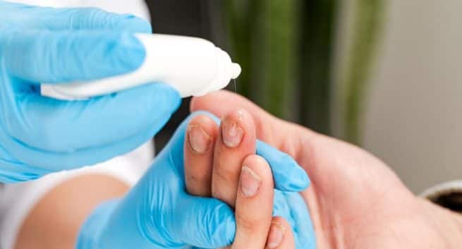What Causes The Skin Around Your Nails To Peel? Skin Expert Explains