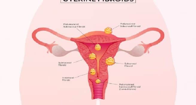 Lifestyle Modifications One Must Adopt to Manage Uterine Fibroids