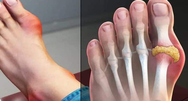 Uric Acid Home Remedies: 7 Ways To Lower Uric Acid Levels Naturally